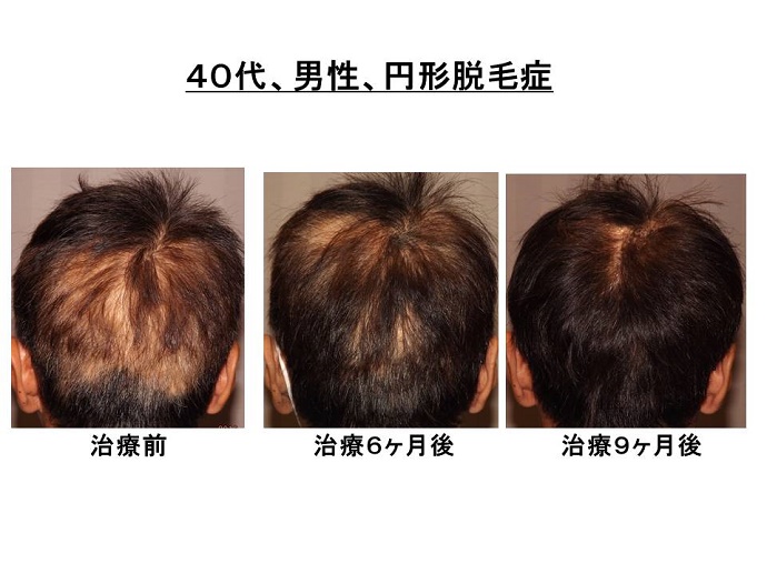 円形脱毛症　病院""